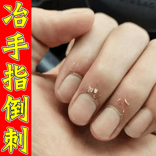 手指倒刺营养油指甲边缘防干裂去死皮肉刺成人儿童去倒刺修复神器