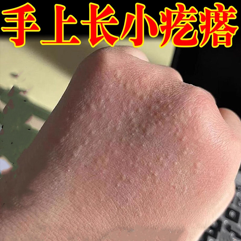 小疙瘩外用顽固手背痒长疙瘩手上过敏乳膏
