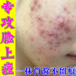脸上下巴长痘痘上火熬夜红肿脓包硬疙瘩痘坑痘印青春痘学生用软膏