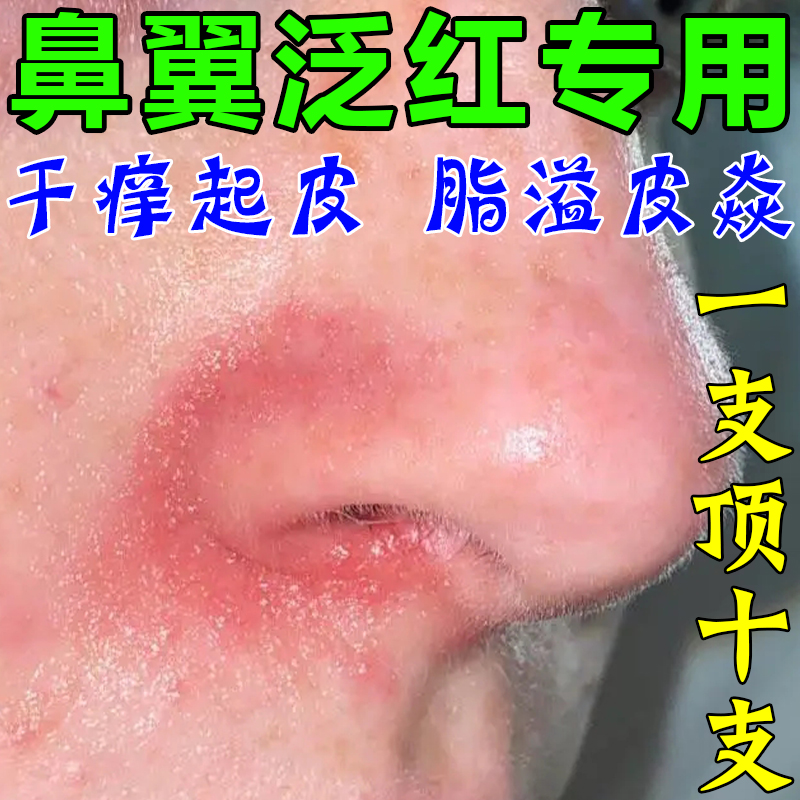 治鼻子两侧发红脱皮鼻翼两边泛红干燥起皮掉皮面部脂溢性皮焱专用