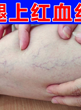 腿上有红血丝毛细血管扩张腿部青筋凸起肿胀疼痛用