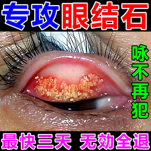 眼结石眼药水眼睛有异物感专用洗眼液清理眼角滴眼液泪眼去除