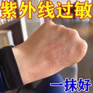 紫外线过敏太阳晒伤皮肤发痒修复霜日光性皮炎