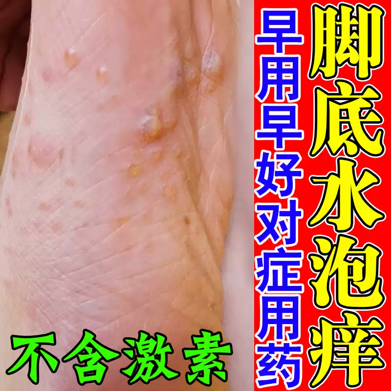 脚底上起小水泡又痒又脱皮脚痒掉皮烂脚丫根脚止杀菌药气水疱型