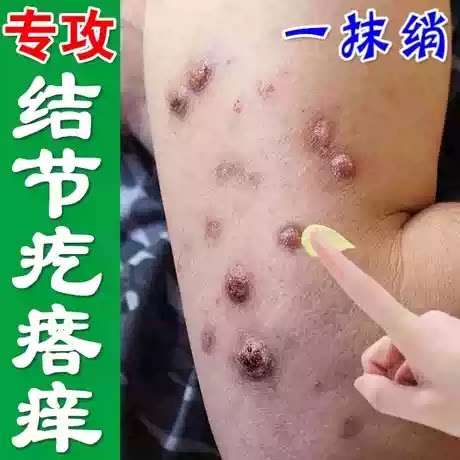 结节性痒疹特治顽固硬疙瘩效痒止全身痒皮肤红斑瘙痒湿毒抑菌药专