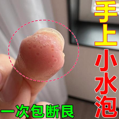 手痒起小水泡手气止痒脱皮杀菌皮肤瘙痒过敏手指长水泡百草止痒膏
