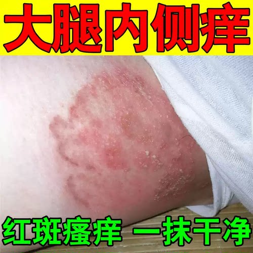 烧裆药防胖人夏天走路出汗男女大腿内侧根部发痒防摩擦膏烧档红肿