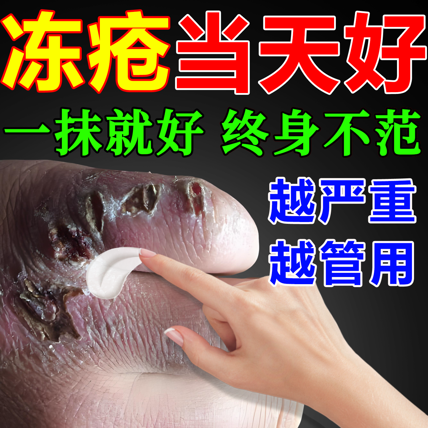 冻疮膏止痒冻伤膏膏药防冻裂成人儿童冻耳朵手脚脸部冻疮神器