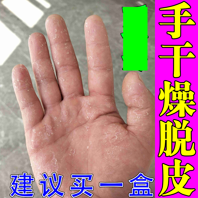 手足皲裂疼痛真菌感染专用修复药