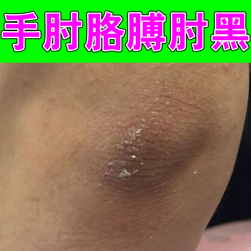 手肘胳膊肘黑皮肤干脖子后面黑儿童洗不干净去死皮淡化黑色素沉淀