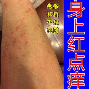 身上红点痒小腿起疙瘩长鳞屑红斑疥疮皮肤红痒痘痘紫外线过敏专用