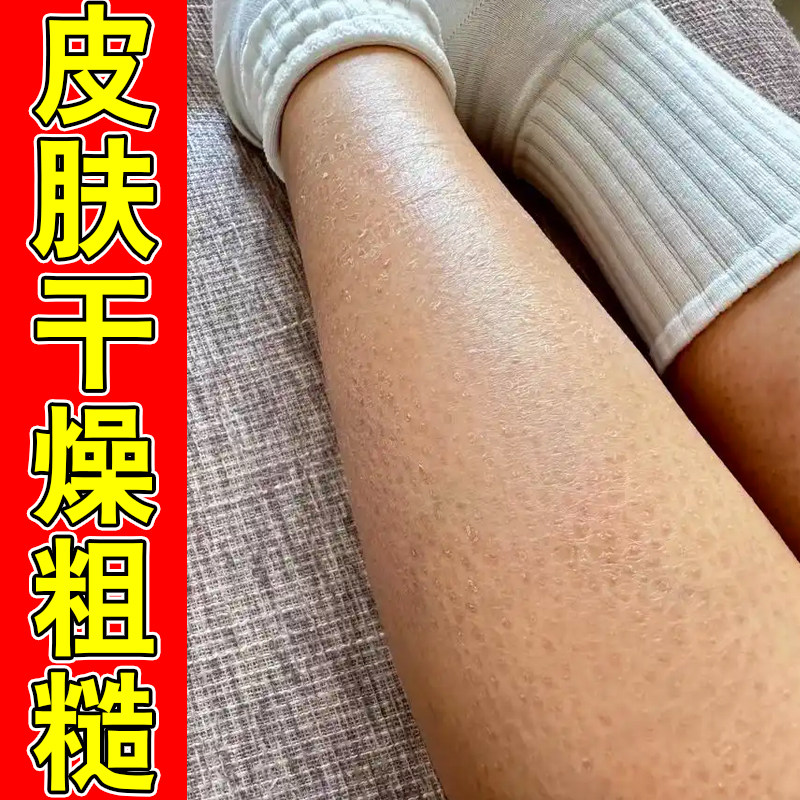 腿部频繁起白屑干燥润肤露鱼鳞肤质全身保湿舒缓粗糙起皮修护身体