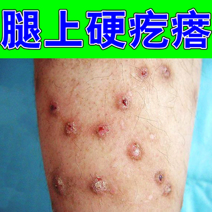 疙瘩痒接触性特应性过敏全身皮肤痒红斑脱屑四肢长硬疙瘩