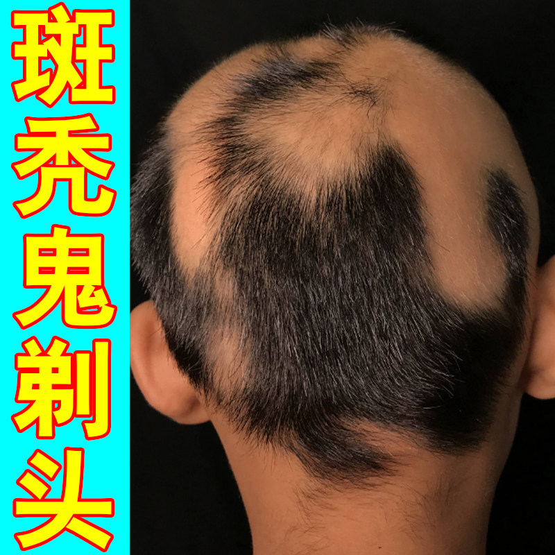 轻度斑秃局部头发稀少头皮滋养精华呵护毛囊减少掉块舒缓头皮日常