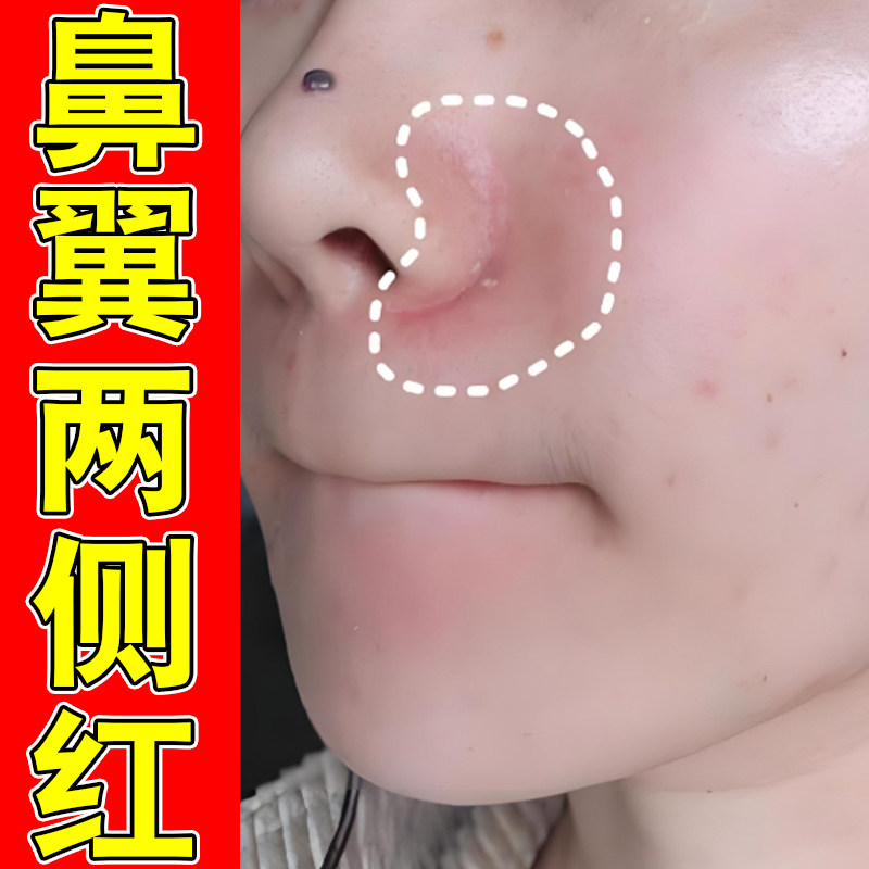 鼻翼两侧红鼻周泛红起痘小疙瘩鼻翼发红脱皮掉皮脂溢性酒糟鼻草本