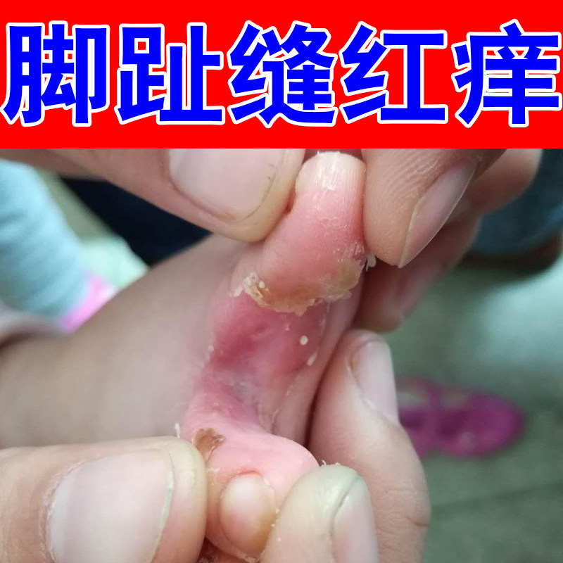 脚趾缝红痒脚底板起皮掉屑脚后跟干裂口鳞屑型脚趾间泛白红肿干痒