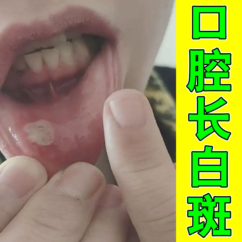 口腔内壁破皮嘴唇内侧破损吃饭摩擦疼说话难受反复口腔不适外用药