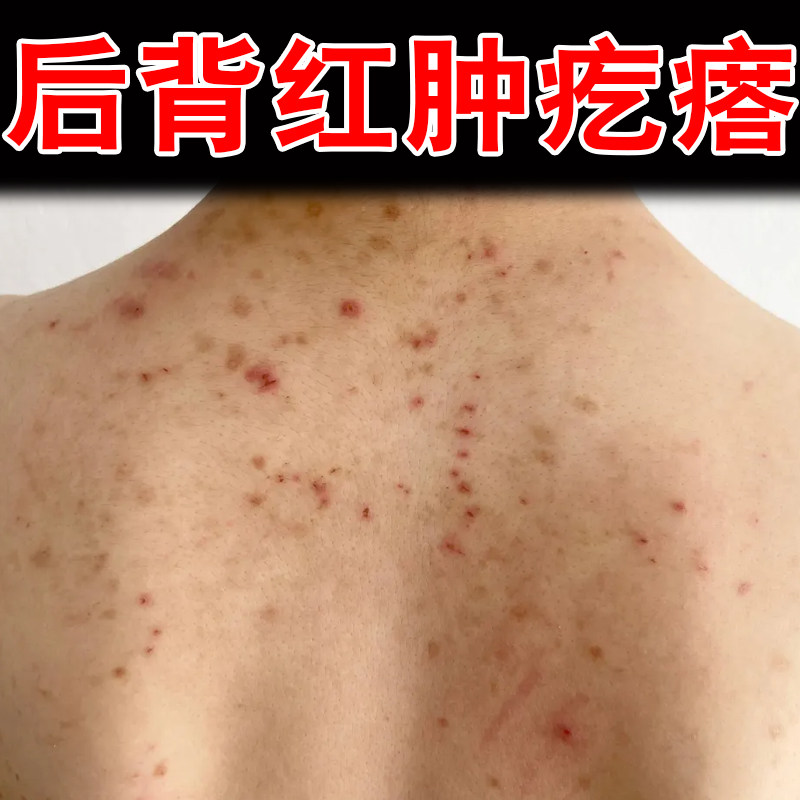 后背红肿疙瘩马拉色菌毛囊堵塞毛孔粗大专用前胸后背红点脓包小痘