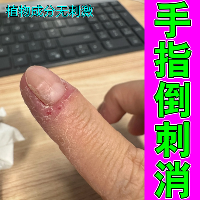 手指起倒刺儿童修复护理有肉刺指甲边缘干裂起皮防倒刺护手霜修护