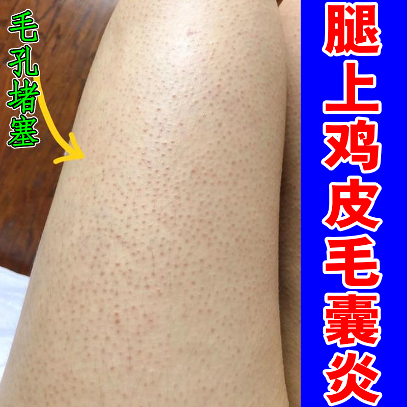 腿上鸡皮毛囊炎长黑点疙瘩粗糙马拉色菌感染小颗粒干燥痒专用修复
