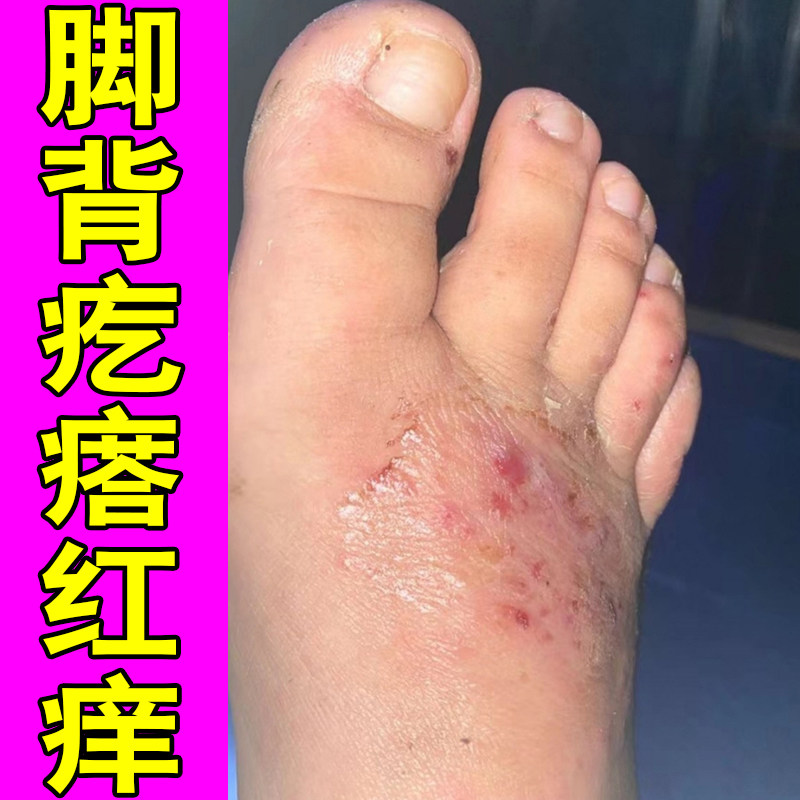 脚背疙瘩红痒掉屑粗糙脚上起红斑脱屑干痒外用脚趾头干燥红肿脚臭