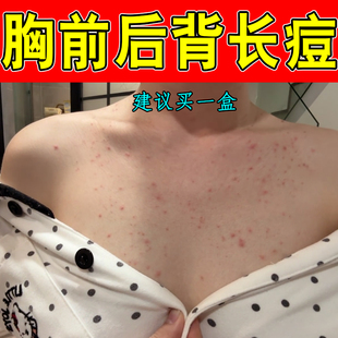 胸前长痘痘疙瘩脓包红肿腮边淋巴痘玫瑰疹马拉色菌毛囊