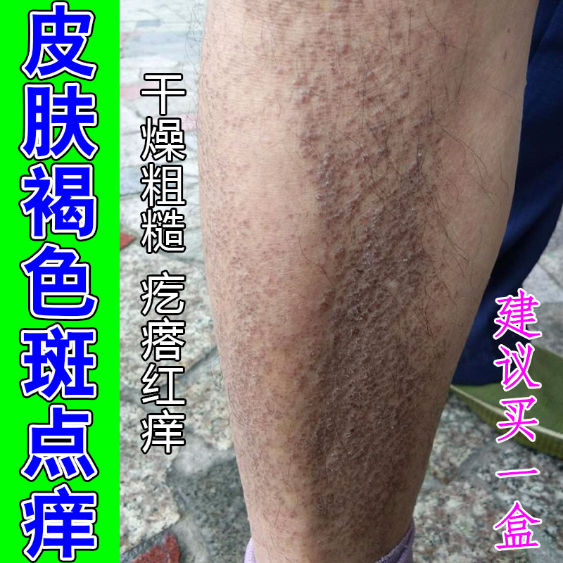 皮肤斑块发硬粗糙起皮色素沉着暗沉纹理杂乱角质堆积肌肤干燥温和