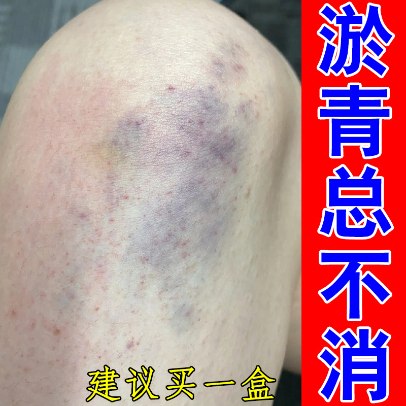 大腿外侧小腿乌青斑块皮下显色暗沉印子碰撞过后肌肤表层淤印草本