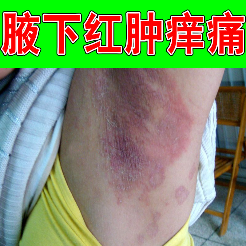 腋下红肿痒痛黑色素沉淀褐色斑点沉积过敏粗糙神经性起红斑小疙瘩