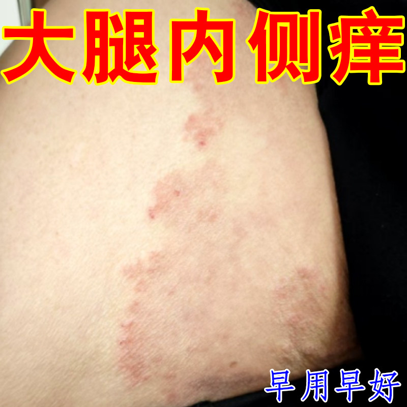 大腿内侧痒身上长红斑男人下面痒掉屑红肿过敏起疙瘩痘痘专用草本