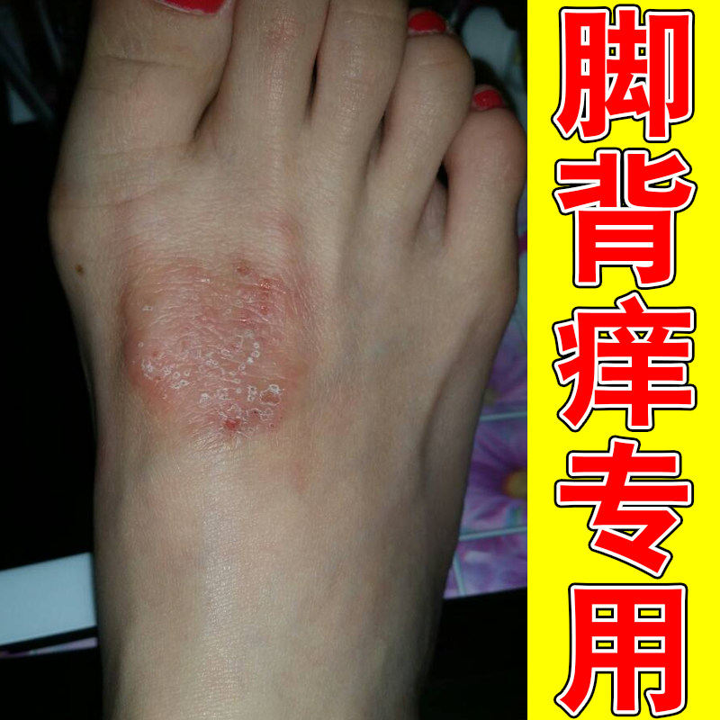脚背痒专用脚踝脚脖子红肿痒长红斑过敏粗糙干燥掉屑红肿长红点痒