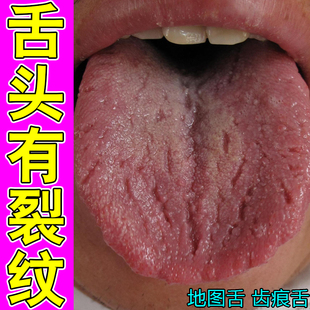 舌头裂痕地图舌齿痕舌调理灼口综合症裂纹有齿痕舌苔白厚冶烂嘴药