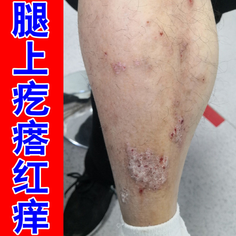腿上疙瘩红痒掉屑皮肤干燥粗糙褐色蛋白沉积黑色素沉淀顽固剧烈痒