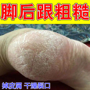 脚后跟粗糙脚脱皮裂口子手指尖蜕皮鳞屑蜕皮防裂皮修复保湿药乳膏