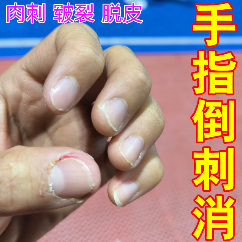 手指倒刺消指甲边缘起皮去死皮干燥脱皮撕裂疼痛去神器皮肤粗糙裂