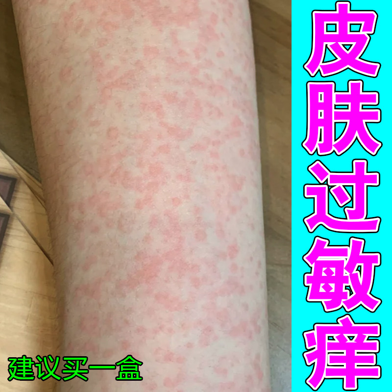 皮肤过敏痒身上长红斑起疙瘩痘痘红点干燥粗糙紫外线过敏专用修护