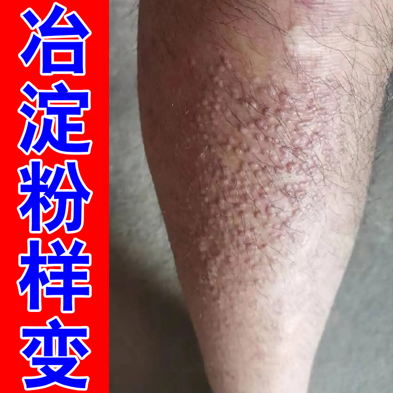 腿上褐色蛋白沉积粗糙颗粒小腿遗留黑色素沉淀老年人身上痒掉屑痒