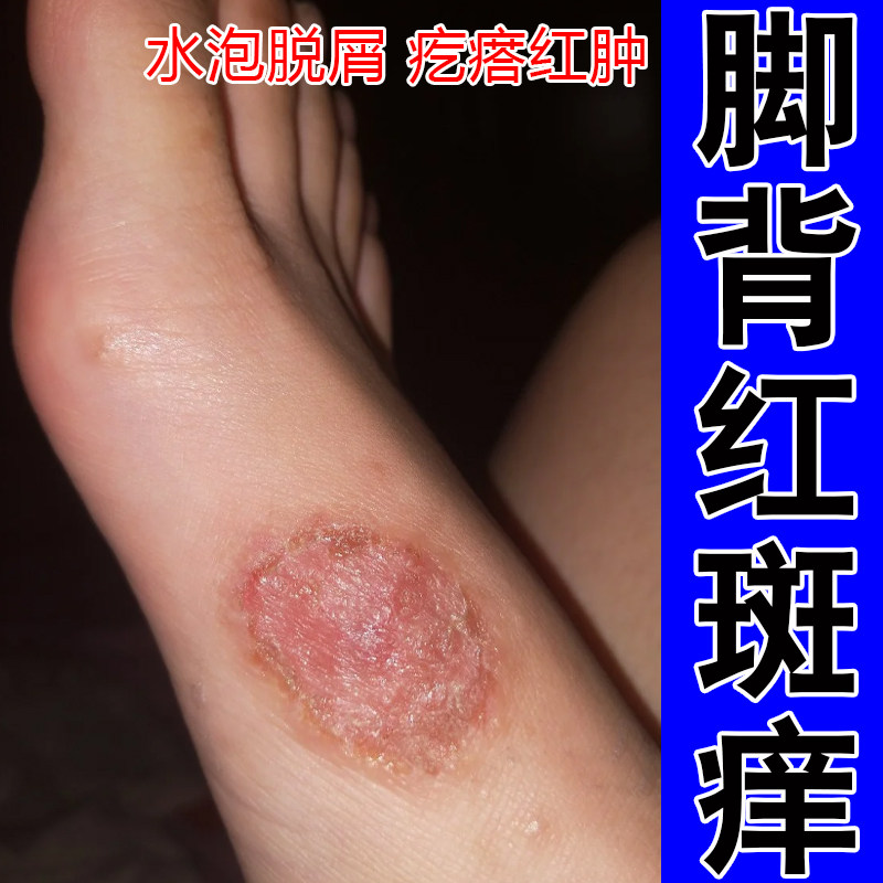 脚背红斑痒脚上红肿疙瘩粗糙掉屑起水泡泛红干燥痒鳞屑修护保湿药