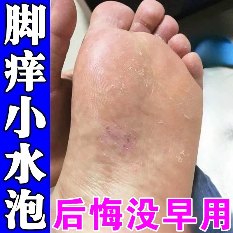 心痒脚脱脚皮脚底起小泡水又痒又脱药皮水型泡脚感痒专膏用