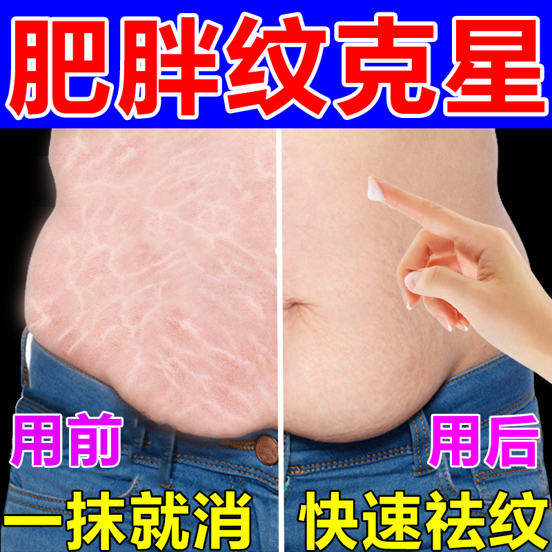 妊辰纹消除去妊娠纹紧致肚皮产后肥胖纹去除男生消大腿学生修复霜