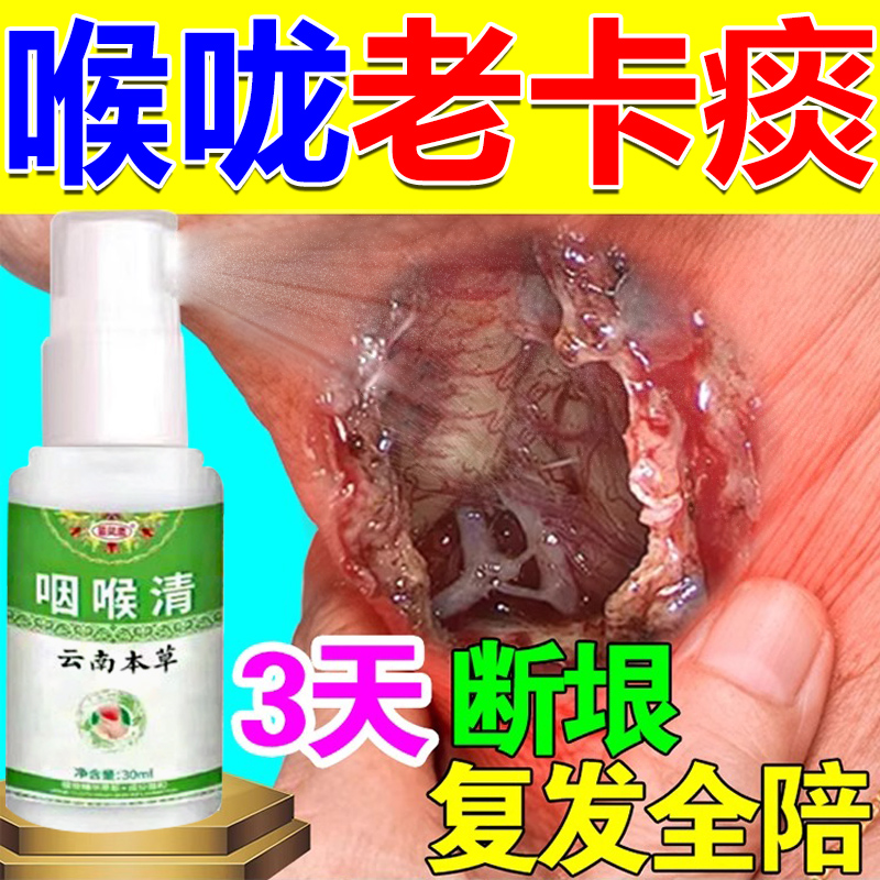 痰多吐不完粘嗓子不舒服老有痰喉咙干痒咳嗽有异物痰液粘稠喷雾剂