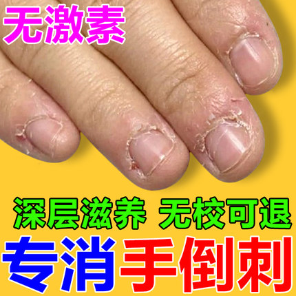 手指倒刺营养油儿童修复去手上长刺干裂脱皮神器指甲边缘保护理霜
