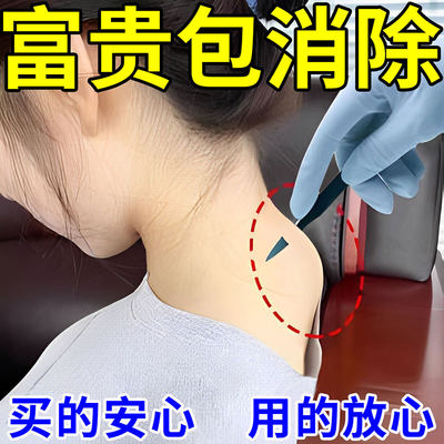 【消除神器】解决各种颈椎问题脖子酸痛僵硬鼓包堵塞专用贴