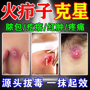 火疖子拔毒膏外阴火疖子屁股上长火疖子拔毒拔脓膏脓包硬块火疖子