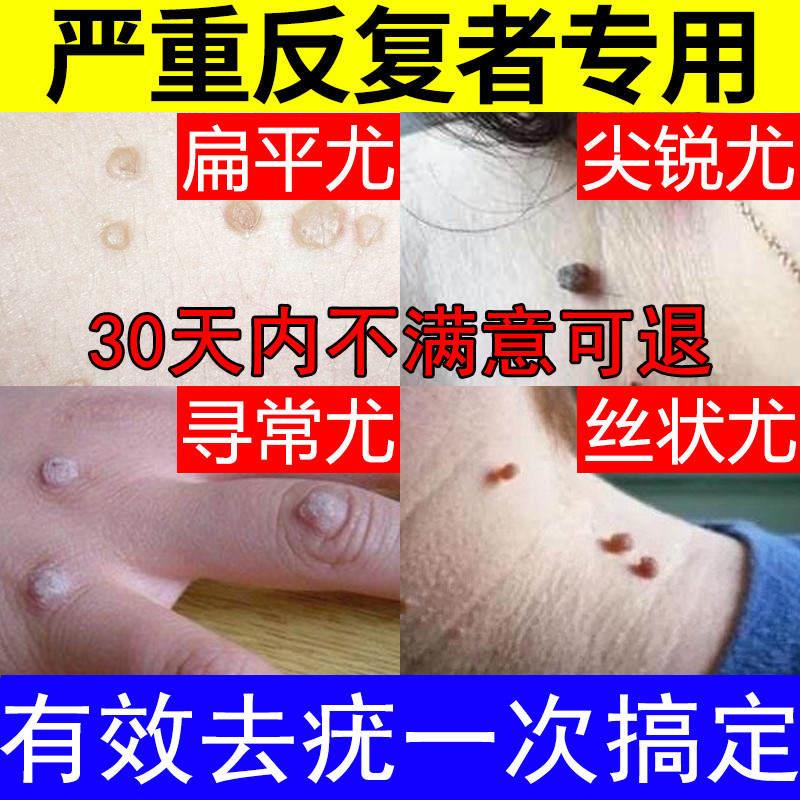 速发氟啶嘧尿软膏鸭胆子去瘊灵丝状疣滴除神器疣去去疣灵跖疣净肉