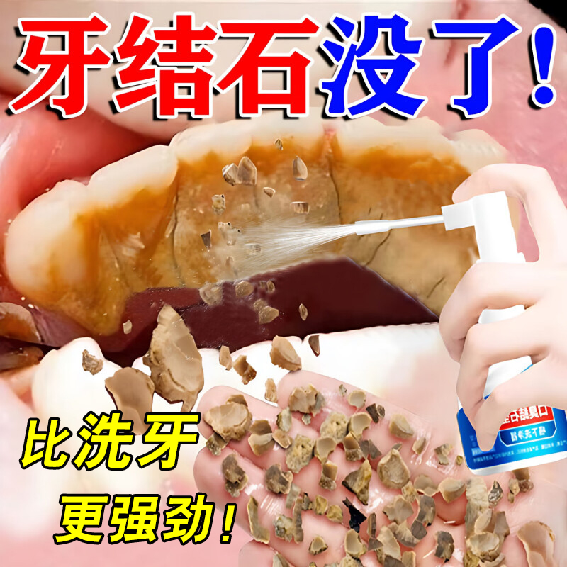 【香港國医】牙结石溶解喷剂医用去牙结石溶解牙石速效清理去除器
