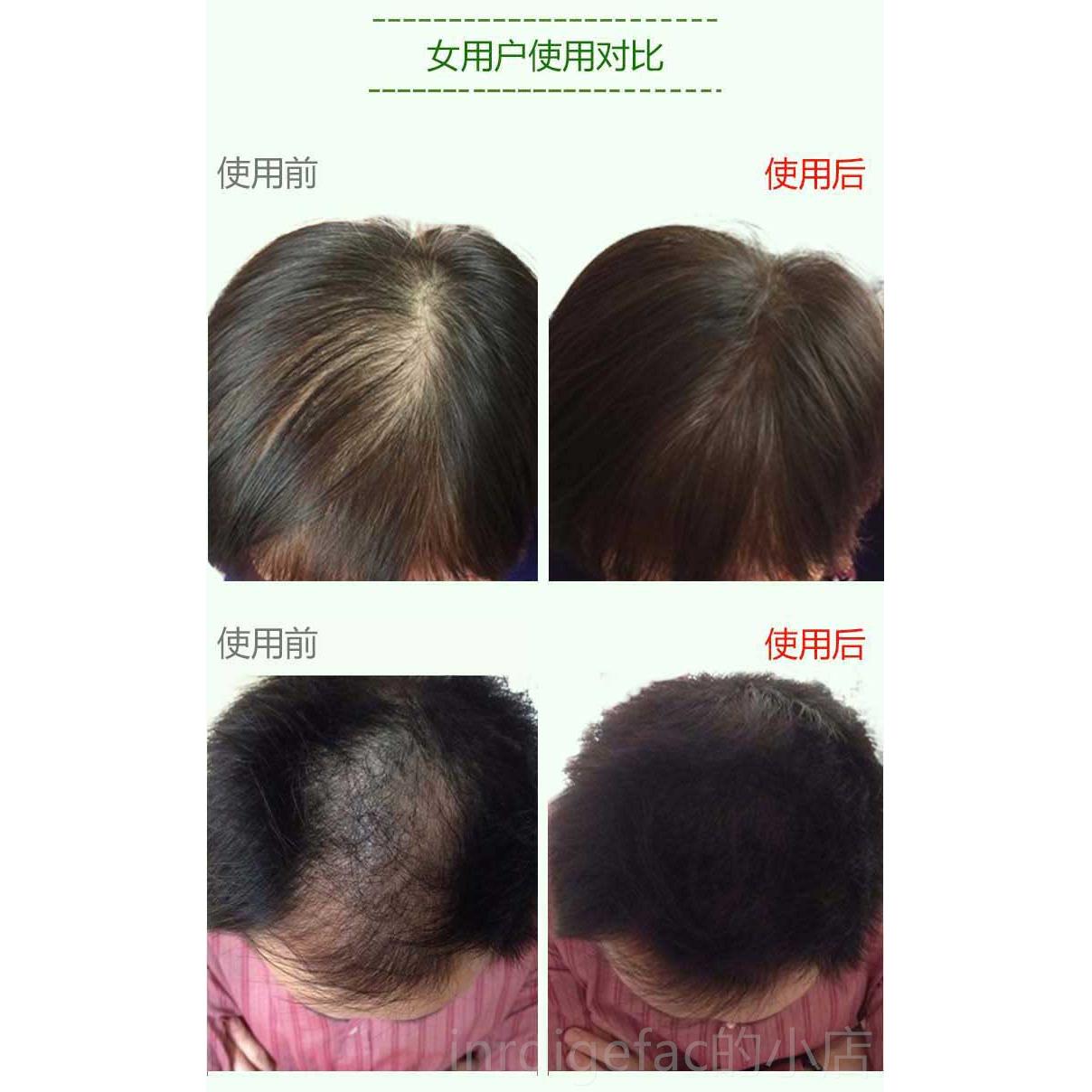 新款增纤发维头发纤维粉美发假发男补女浓密发粉发顶盖丰稀遮疏