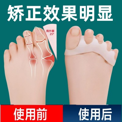 婴儿幼儿童脚趾矫正器小孩大拇指重叠外翻弯曲畸形矫形纠正分趾器