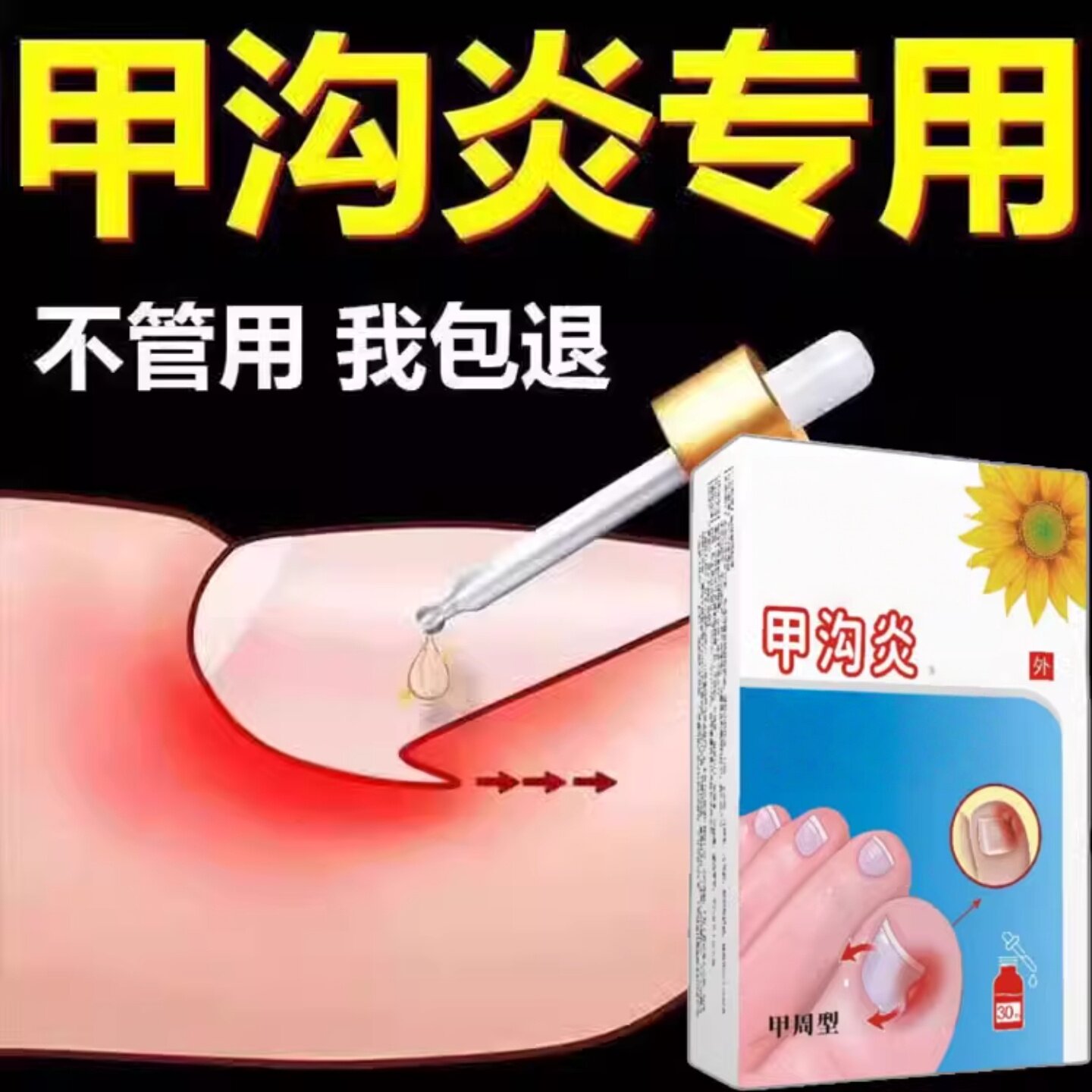 疗专脚趾甲往肉里长用正品消肿去肉芽嵌甲化脓息肉去
