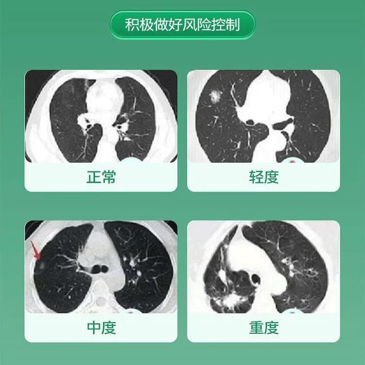 OAP喉咽炎性咽炎扁桃体有慢痰异有物感咽喉干痛干咳嗓子干痒